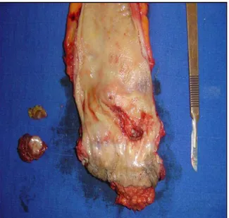 Figure 22 : Pièce d’AAP + deux pièces de métastasectomie réalisées chez un patient   de notre étude