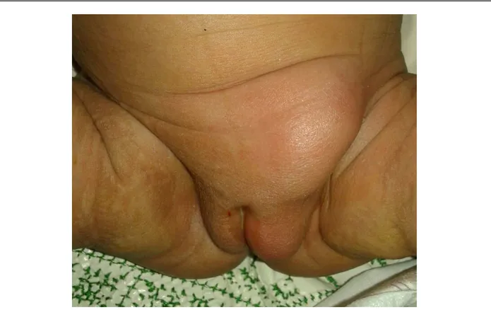 Figure 5: Tuméfaction inguinale avec des signes inflammatoires chez un NN de sexe féminin en  rapport avec une hernie étranglée
