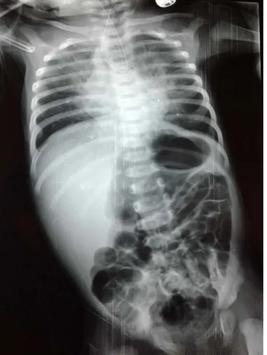 Figure 10: Radiographie thoraco-abdominale sonde en place montrant un enroulement de cette  dernière, en faveur d’une atrésie de l’œsophage de Type III 