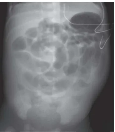 Figure 13: ASP de face debout montrant un arret de l'aération colique au niveau de la région  pelvienne, en faveur d'une atrésie colique [51] 