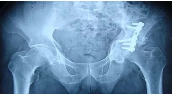 Figure 20: Radiographie post op montrant une arthrose post traumatique de la hanche gauche 