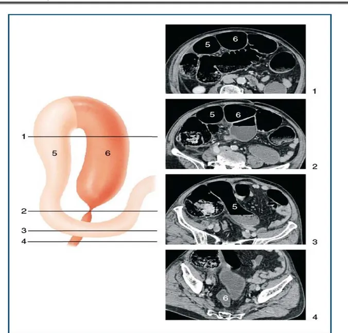 Figure 12. : Volvulus organo-axial du sigmoïde : aspect scannographique. Les coupes 1 à 4 sont  repérées sur le schéma