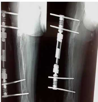 Figure 10 :Patient agé de 20ans, présentant une PSA  atrophique aseptique de la diaphyse    fémorale traitée initialement par un FE 