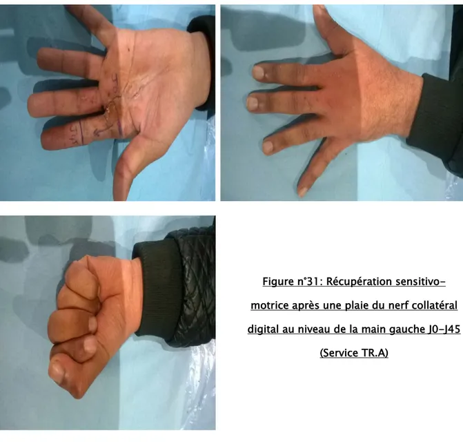 Figure n°31: Récupération sensitivo- sensitivo-motrice après une plaie du nerf collatéral  digital au niveau de la main gauche J0-J45 