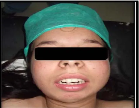 Figure 30 : Photo de face d’une malade présentant une limitation de l’ouverture buccale avec 