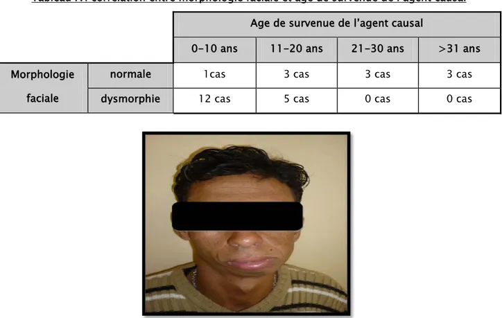 Tableau IV: corrélation entre morphologie faciale et âge de survenue de l’agent causal  Age de survenue de l’agent causal 
