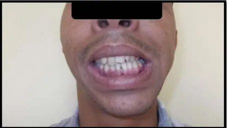 Figure 40: Image d’un cas d’ankylose unilatérale de l’ATM avec obliquité du plan occlusal                                                                                                            (Iconographie du service de chirurgie maxillo-faciale du CHU de Marrakech) 