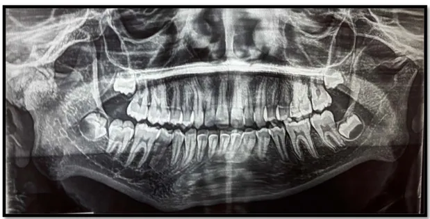 Figure 44 : Panoramique dentaire d’une patiente objectivant une ankylose unilatérale de l’ATM 