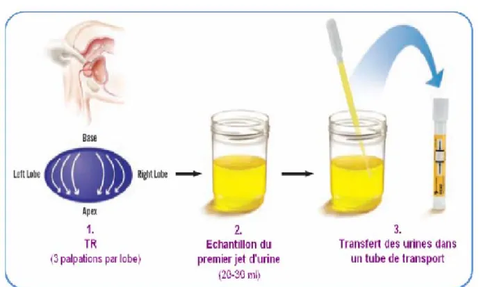 Figure 10: Modalités de prélèvement des urines pour la réalisation du test urinaire PCA3 [86] 