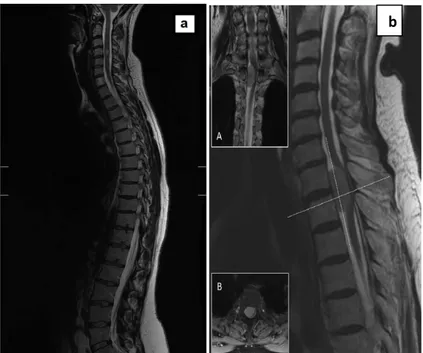 Figure 13 : IRM médullaire normale, coupe sagittale (a). Patiente âgée de 82 ans, ayant un méningiome  thoracique antérieur, situé au niveau  T2-T3 (b) : IRM pondérée en T2, coupes sagittale et coronale : la  tumeur émet un signal d’intensité intermédiaire