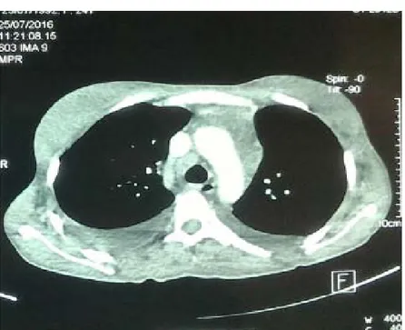 Figure 16 : TDM thoracique en fenêtre médiastinale montrant des adénopathies    de la loge de bartey avec épanchement pleural minime bilatéral