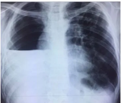 Figure 24 : Radio de thorax face montrant un comblement de la cavité   résiduelle de la pneumonectomie