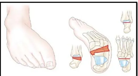 Figure 25:Aspect du pied varus. [12]  L’équinisme : 
