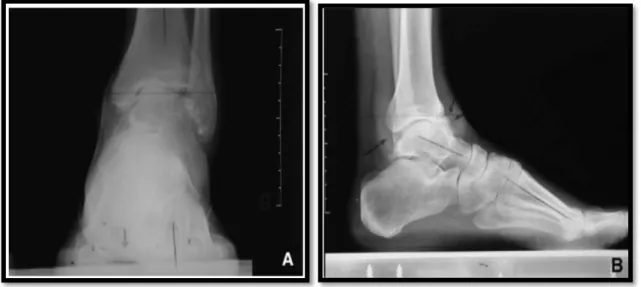 Figure 30: Arthrose tibio-talienne après entorse à répétitions.  (A)  de face, la bascule talienne en varus, l’absence de dislocation de la pince