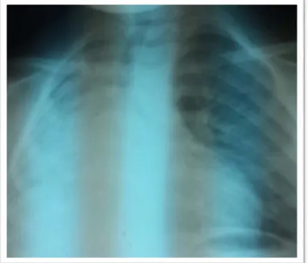 Figure n°15 : Aspect radiographique d’une atélectasie pulmonaire droite d’une enfant de 2ans,  suite à une inhalation de deux haricots blancs