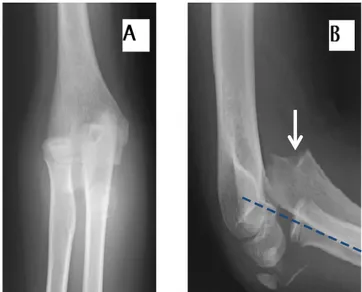 Figure 14 : Luxation antérieure du coude droit associée à une fracture de l’olécrane chez un  garçon de 10 ans 