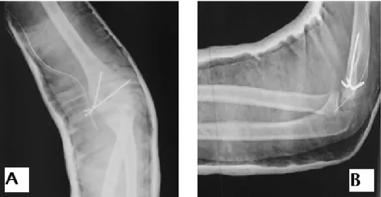 Figure 20 : Luxation postérieure du coude gauche associée à une fracture de l’épitrochlée,chez  un garçon de 12 ans, après réduction et embrochage 