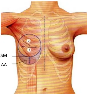 Figure 31 : Dessins des différents points fixes et du LAA qui amène 2 à 5 cm de peau.[21]  •  Déroulement de l’intervention : 