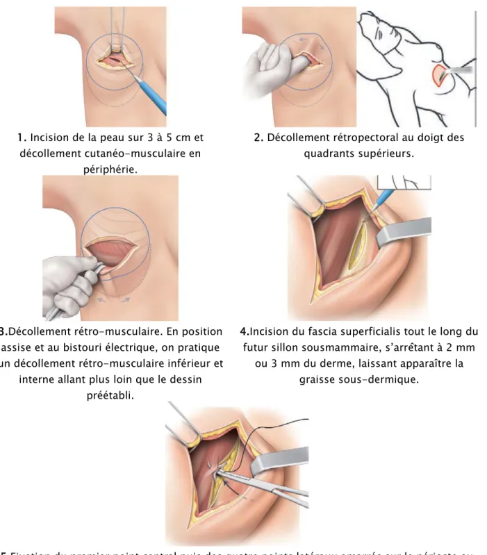 Figure 32 : Etapes de la reconstruction secondaire par prothèse.[21] 