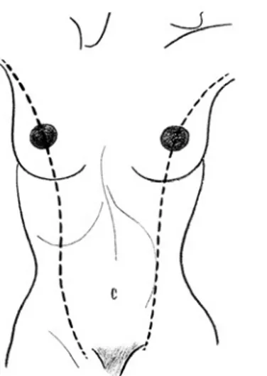 Figure 3 : Emplacement des mamelons et glandes mammaires surnuméraires, le long de la crête  mammaire.[19] 