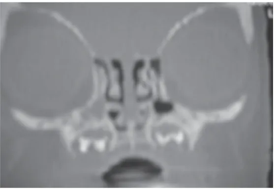 Figure 3 : Visualisation du labyrinthe ethmoïdal et du sinus maxillaire gauche  par examen  tomodensitométrique chez un nouveau-né, coupe coronale 