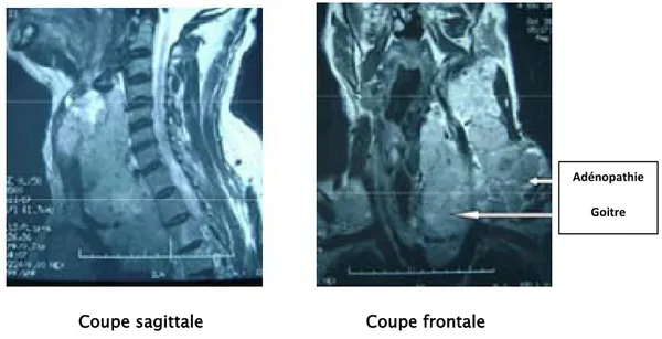 Figure n° 9 : IRM en coupe sagittale et coronale : goitre plongeant avec multiples adénopathies  cervicales [Iconographie du service d’ORL de l’Hôpital Militaire Avicenne Marrakech]
