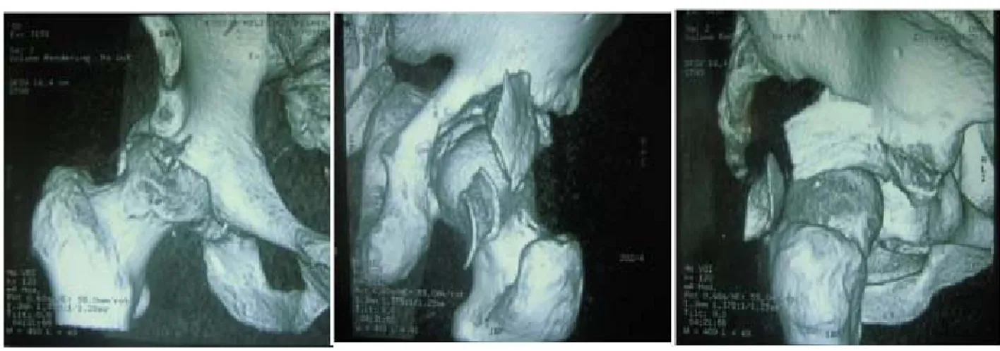 Figure 7 : (A, B, C): une reconstruction 3D d’une fracture comminutive de la paroi postérieure 