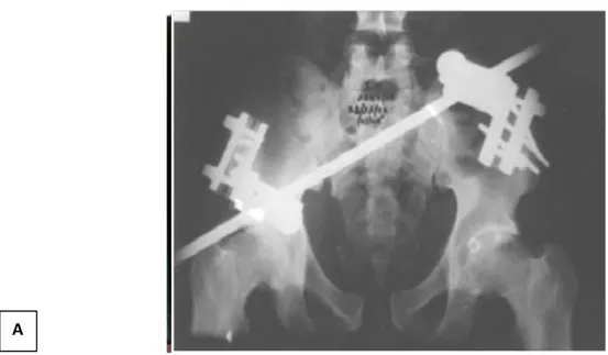 Figure 9 : Radiographie de face du bassin chez un patient qui présente une disjonction pubienne   après réduction et fixation externe  