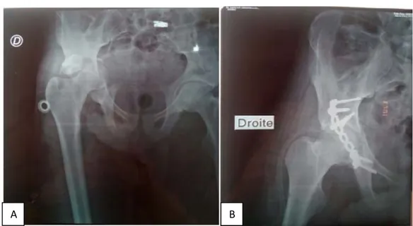 Figure 12 : Radiographies de face de la hanche montrant une fracture transversale et de la paroi  postérieure traitée par plaque vissée 