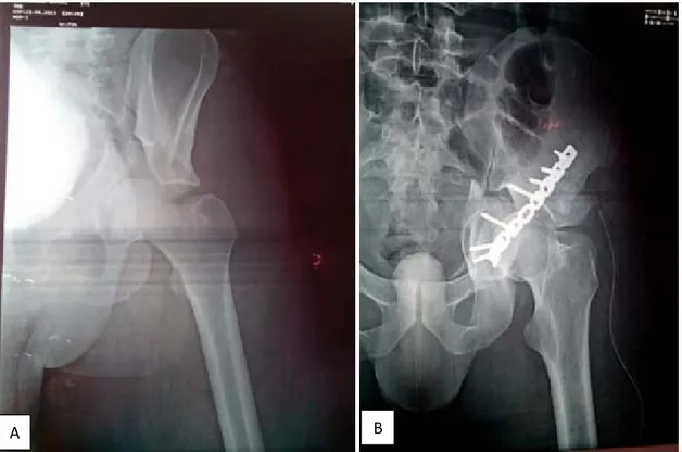 Figure 14 : Radiographie de la hanche de face montrant une fracture transverse avec  enfoncement acétabulaire central 