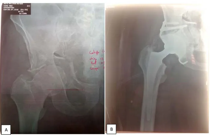 Figure 15 : Radiographie de la hanche de face montrant une fracture de la colonne antérieure déplacée  B après traitement par PTH 