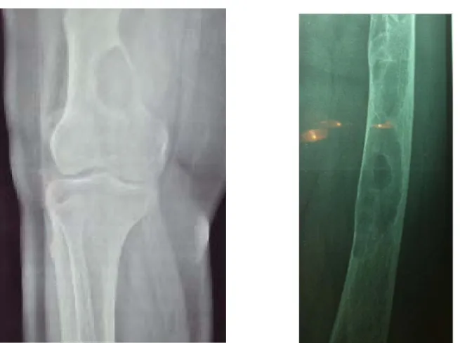 Figure 6 : Radiographies standard face du fémur et du genou montrant des métastases osseuses  d’un CTD chez deux de nos patients (aspects ostéolytiques au niveau du fémur)