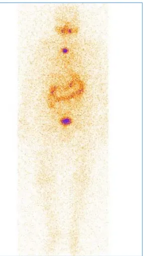 Figure 17 : Scintigraphie à l’iode 131 montrant une fixation au niveau thyroïdien chez un de nos  patients