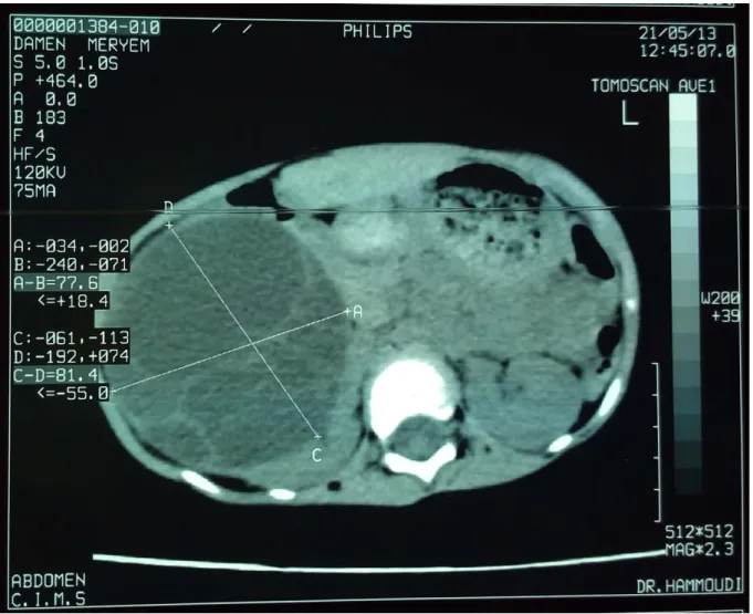 Figure 11: Image scannographique montrant un néphroblastome rénal droit. Rein droit Rein gauche Bilatérale 3.12% 43.75% 53.12% 