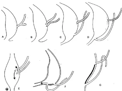 Figure 20 : Evolution du canal de Wolff, du bourgeon urétéralet de l’uretère 