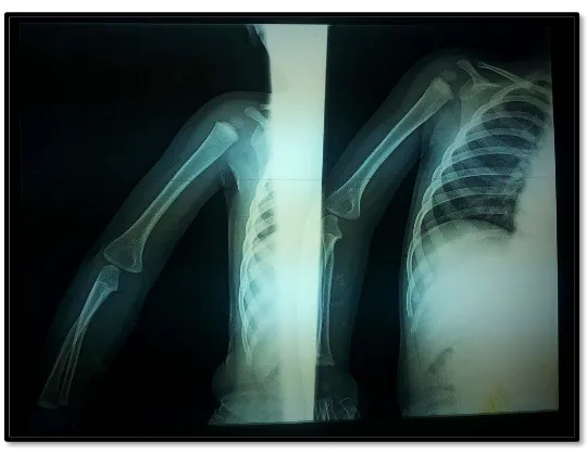 Figure 15: Radiographie de l’épaule droite face/profil chez un patient présentant une  POPB droite 