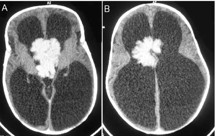 Figure 12 : TDM cérébrale en coupe axiale (a) et en reconstitution coronale (b) objectivant un  papillome des plexus choroïdes du troisième ventricule spontanément isodense prenant le 