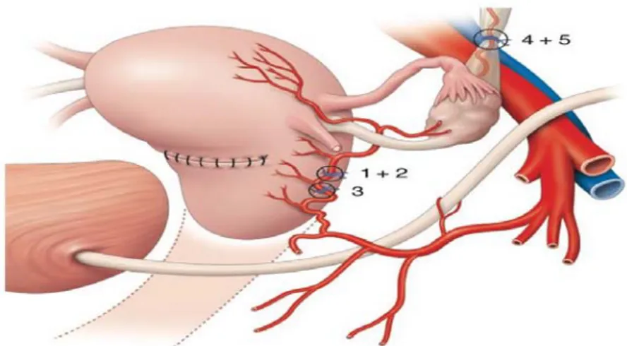 Figure 12 :La ligature étagée ou stepwise La ligature étagée ou stepwise : ligature unilatérale  puis bilatérale des artères utérines ( 1+2), ligature basse des deux artères utérines ( 3), ligature 