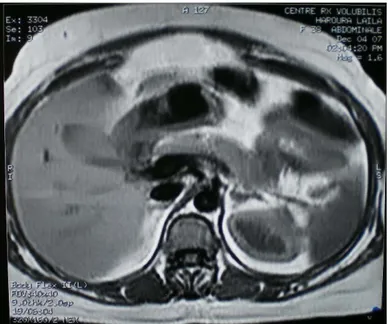 Figure 10 : IRM de l’abdomen (coupe axiale en pondération T1) montrant un pancréas d’aspect normal