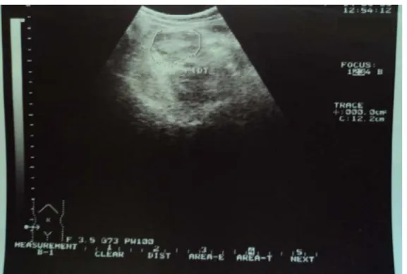 Figure 2 : échographie montrant l’image d’un abcès appendiculaire chez une de nos patientes 