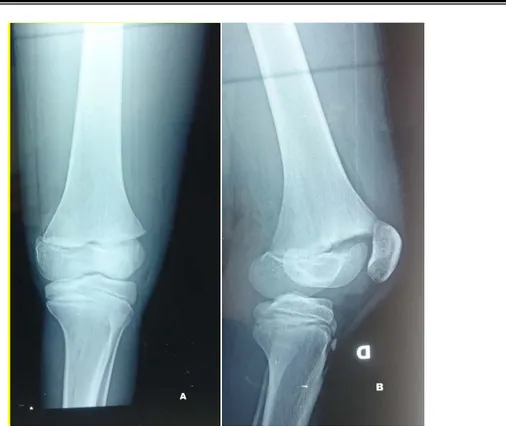 Figure 15: Radiographie de genou d'un enfant âgé de 13 ans face (A) et profil (B) objectivant une  FDE Salter I de l'extrémité inférieure de fémur doit 
