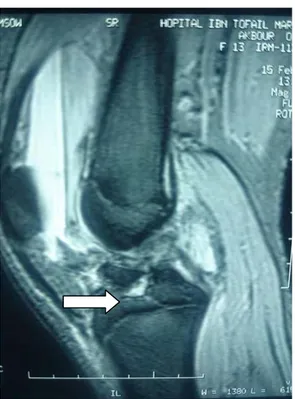 Figure 26: Coupe d’IRM sagittale de genou gauche d’un garçon de 15 ans objectivant une 