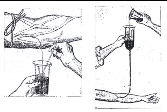Figure 5 : Technique de Lewisohn pour la transfusion de sang citraté 
