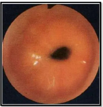 Figure 17 : œsophagite peptique stade I : aspect congestif de la muqueuse œsophagienne 