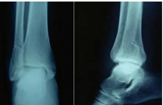 Figure 8 :Fracture bimalléolaire par supination rotation externe  Radiographie de la cheville (F+P)  (Hôpital militaire Avicenne Marrakech) 