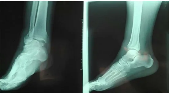 Figure 17:Patient âgé de 35 qui présente une fracture bimalléolaire par supination abduction  Radiographie de la cheville préopératoire (F+P) 