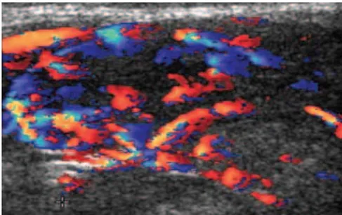 Figure 22 : Écho Doppler-couleur d’une adénopathie présentant une vascularisation diffuse        et anarchique : métastase d’un cancer thyroïdien.[58] 