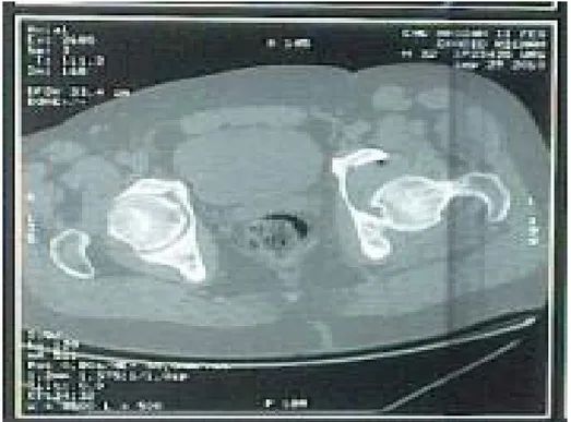Figure 15 : Facture de la colonne postérieure et de la paroi postérieure,  avec une luxation postérieure de la hanche