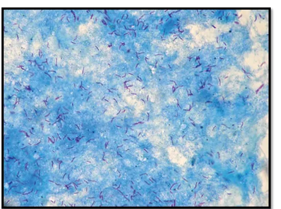 Figure 7: Aspect microscopique de Mycobacterium Tuberculosis après coloration de Ziehl-Nielsen  d