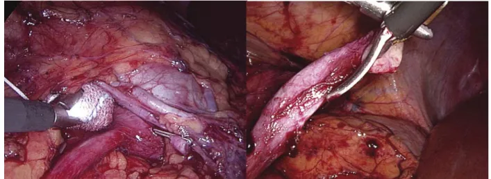 Figure N° 51: croisements vasculaires disséqué avec précaution au dessus   de la JPU après spatulation de l’uretère 